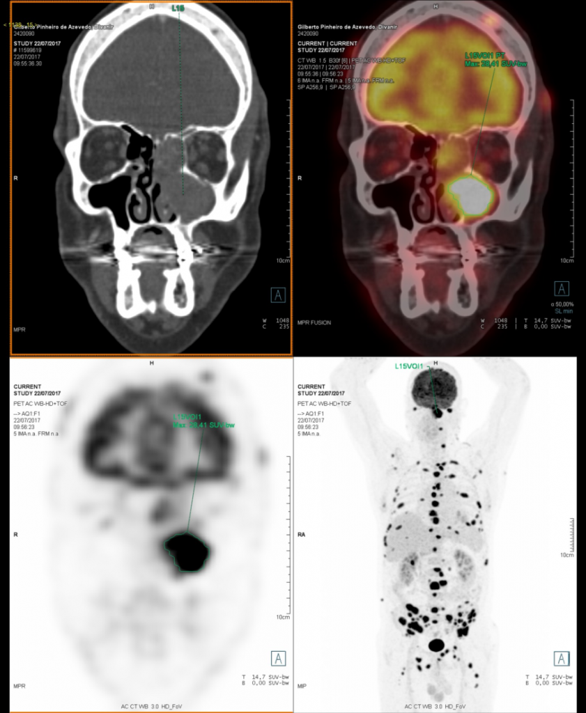 Exames de imagem para o mieloma múltiplo, linfomas e leucemias - Dr ...